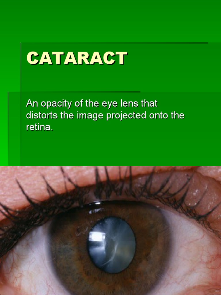 5 Cataract PDF