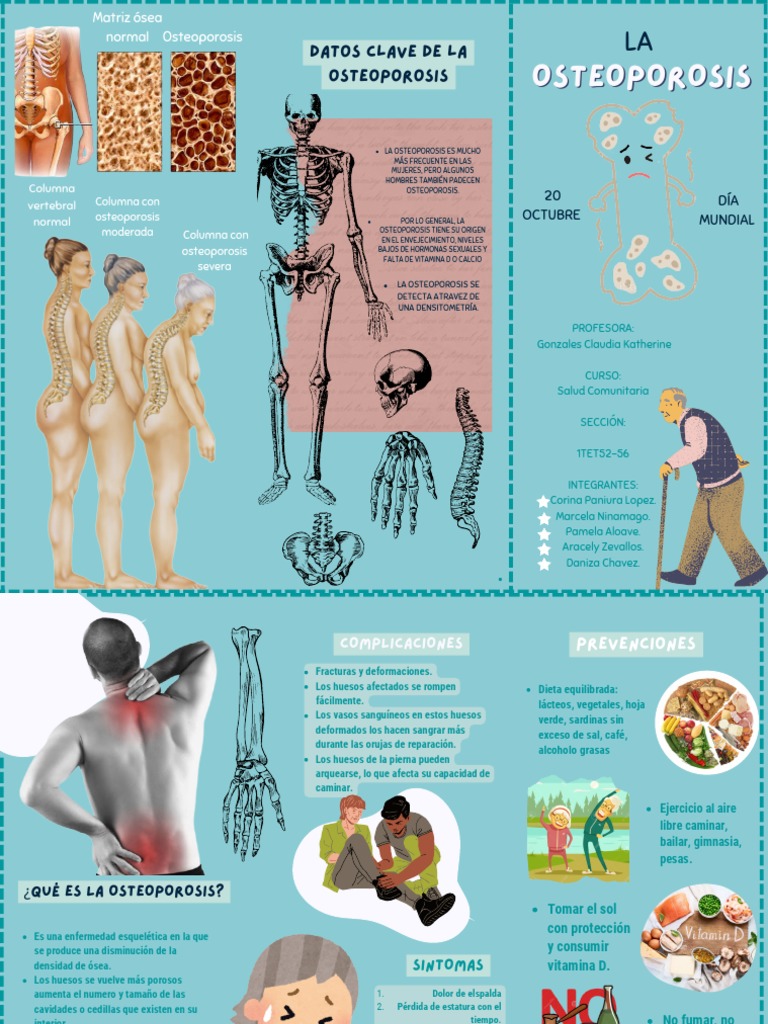 Complicaciones y prevención de osteoporosis | PDF | Osteoporosis | Hueso
