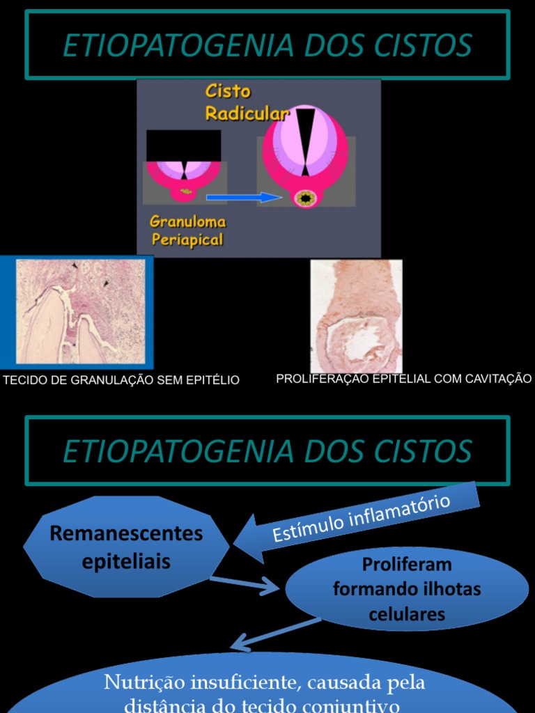 Etiopatogenia e Diagnóstico de Cistos | PDF | Epitélio | Ciências da Saúde