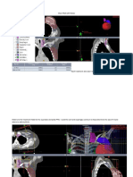 Chest Wall and Nodes