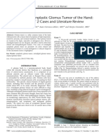 Extradigital Symplastic Glomus Tumor of The Hand: Report of 2 Cases and Literature Review