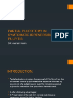 Partial Pulpotomy in Symtomatic Irreversible Pulpitis