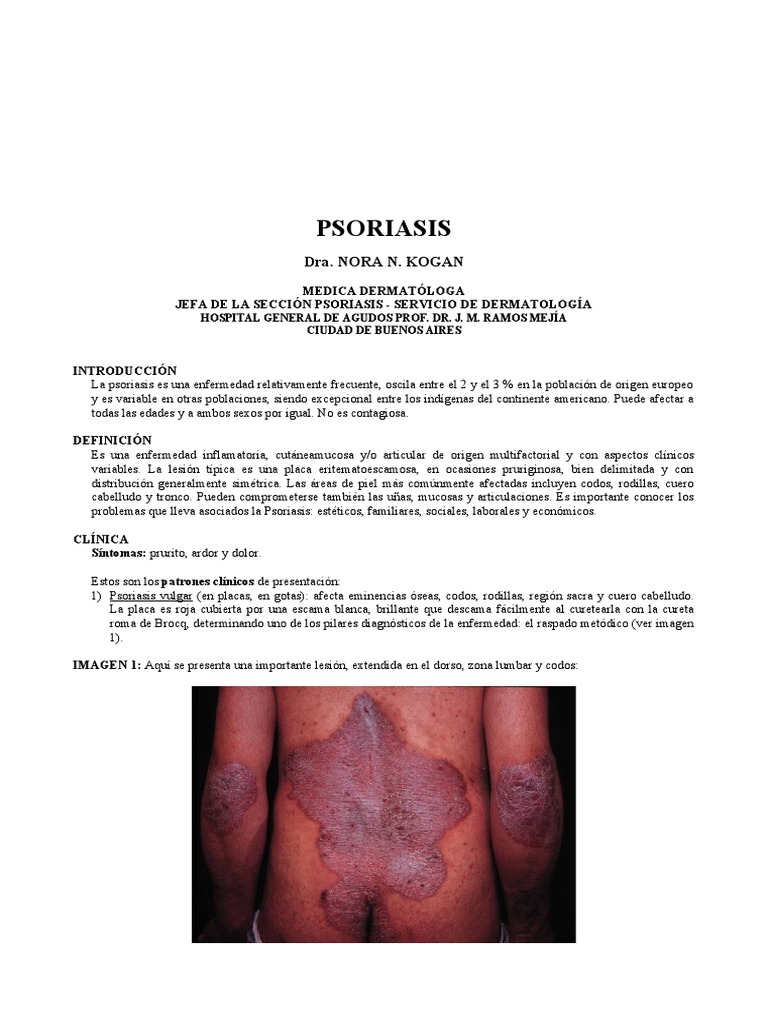 Psoriasis | PDF | Psoriasis | Medicina