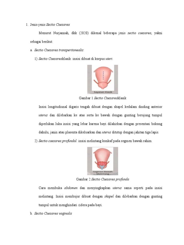 Jenis-Jenis Sectio Caesarea dan Indikasinya | PDF