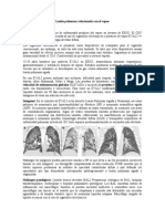 Lesión pulmonar relacionada con el vapeo
