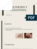 Equimosis y Hematoma