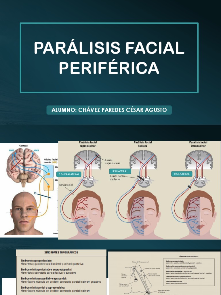 Parálisis Facial Periférica PDF Cabeza y cuello humanos Medicina