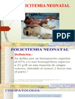 Policitemia Neonatal