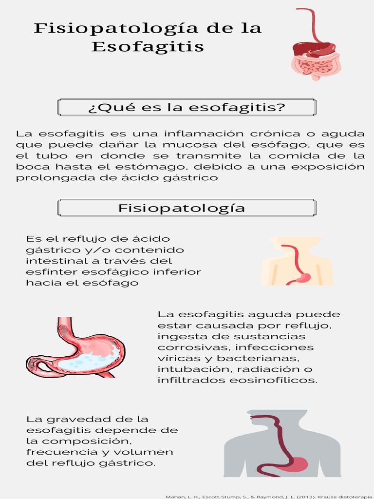 Esofagitis: Síntomas, Causas Y Tratamiento – FZTTQT