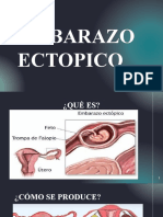 Embarazo Ectopico