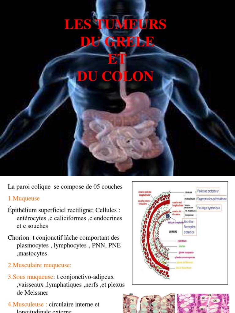 Tumours of the Colon and Rectum | PDF | Cancer du côlon | Cancer