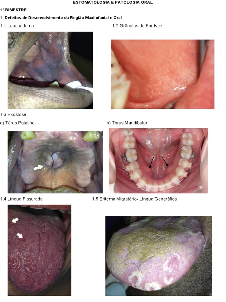 Importância dos aspectos imaginológicos no plano de tratamento da displasia  óssea florida: Relato de caso, image size:768x1024