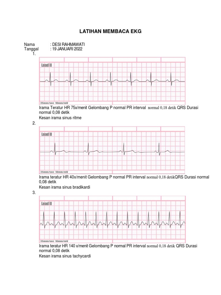 Latihan Interpretasi EKG Sinus | PDF | Seni