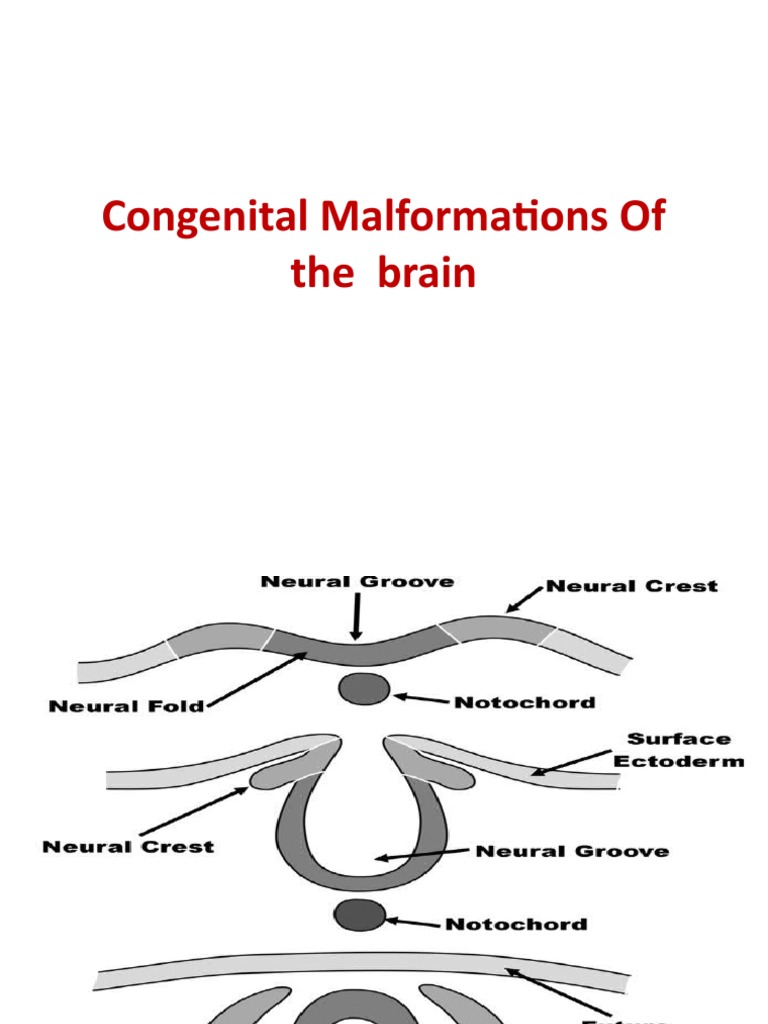 Congenital Malformations of The Brain | PDF | Corpus Callosum ...
