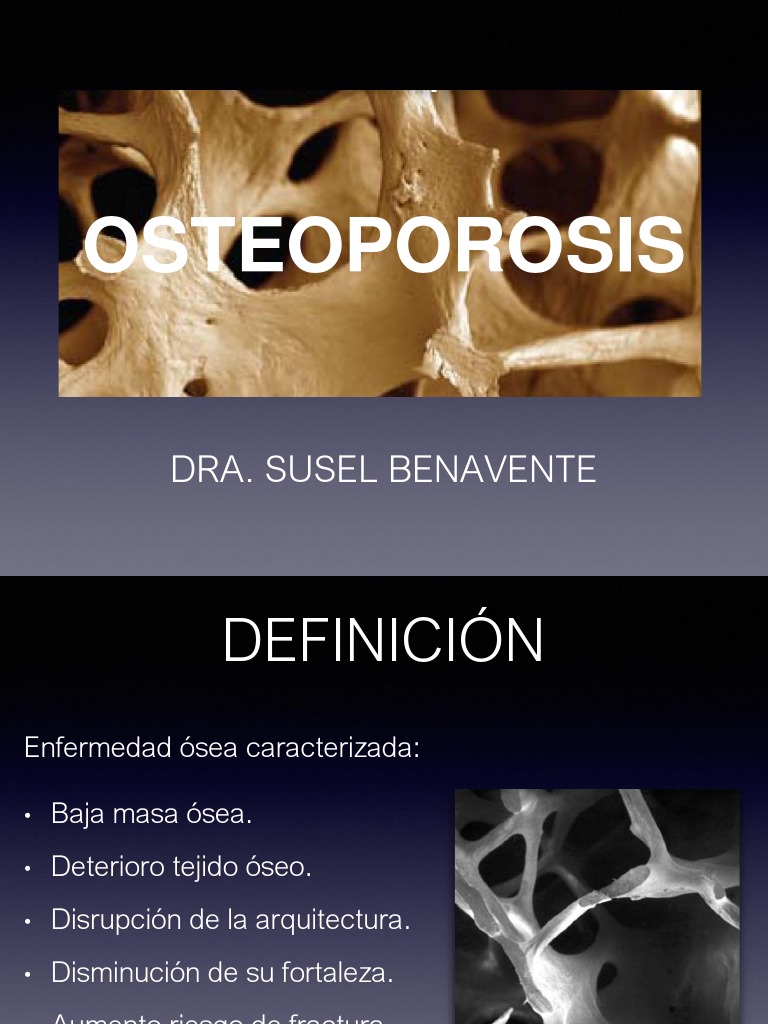 Guía Completa sobre Osteoporosis | PDF | Osteoporosis | Hueso