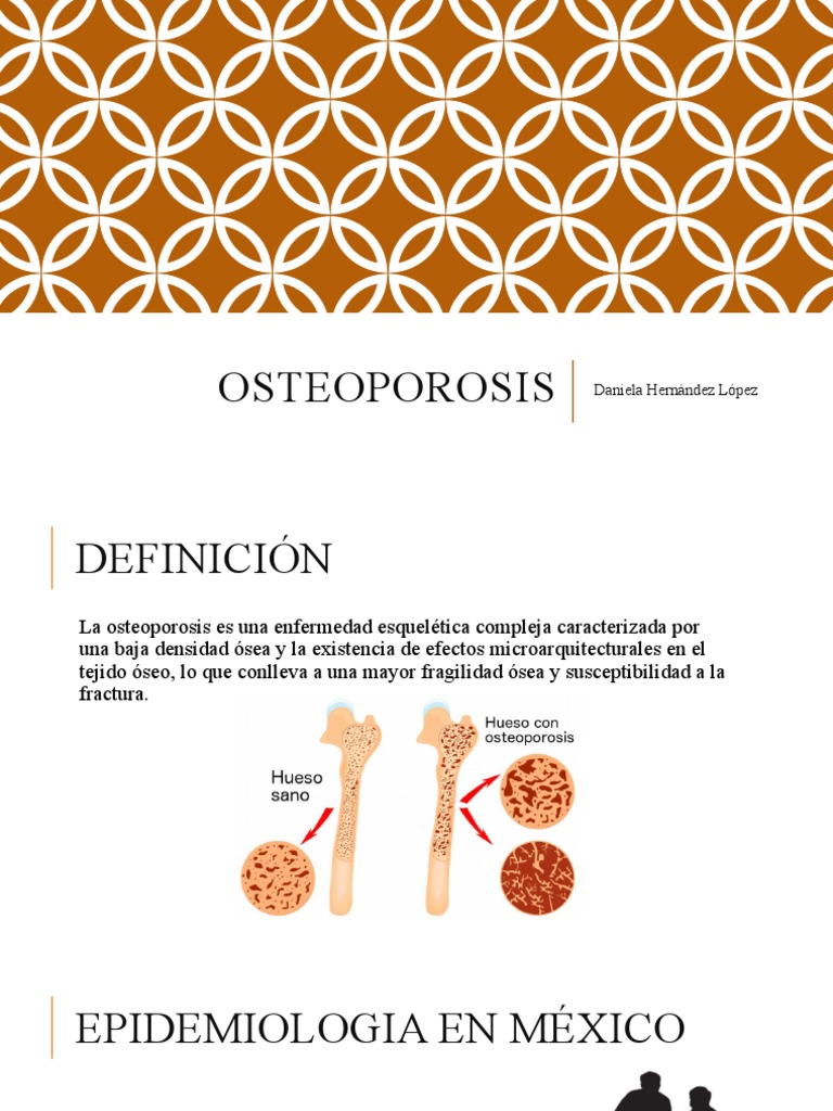 Osteoporosis PDF Hueso Osteoporosis