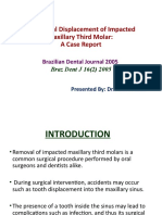 Accidental Displacement of Impacted Maxillary Third Molar JC 2