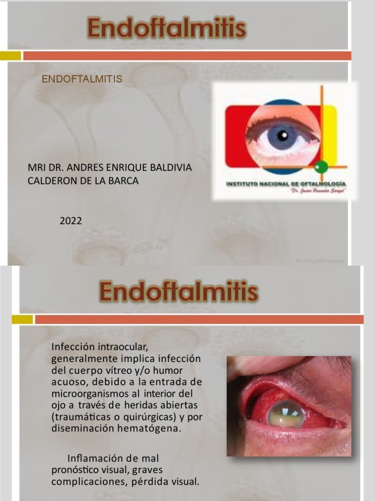 Comprendiendo la endoftalmitis: clasificación, causas, síntomas y ...