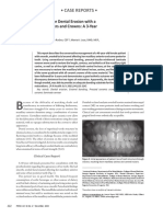 Case Reports - : Restoration of Anterior Dental Erosion With A Combination of Veneers and Crowns: A 3-Year Case Report