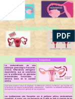 Endometriosis Fisiopatologia