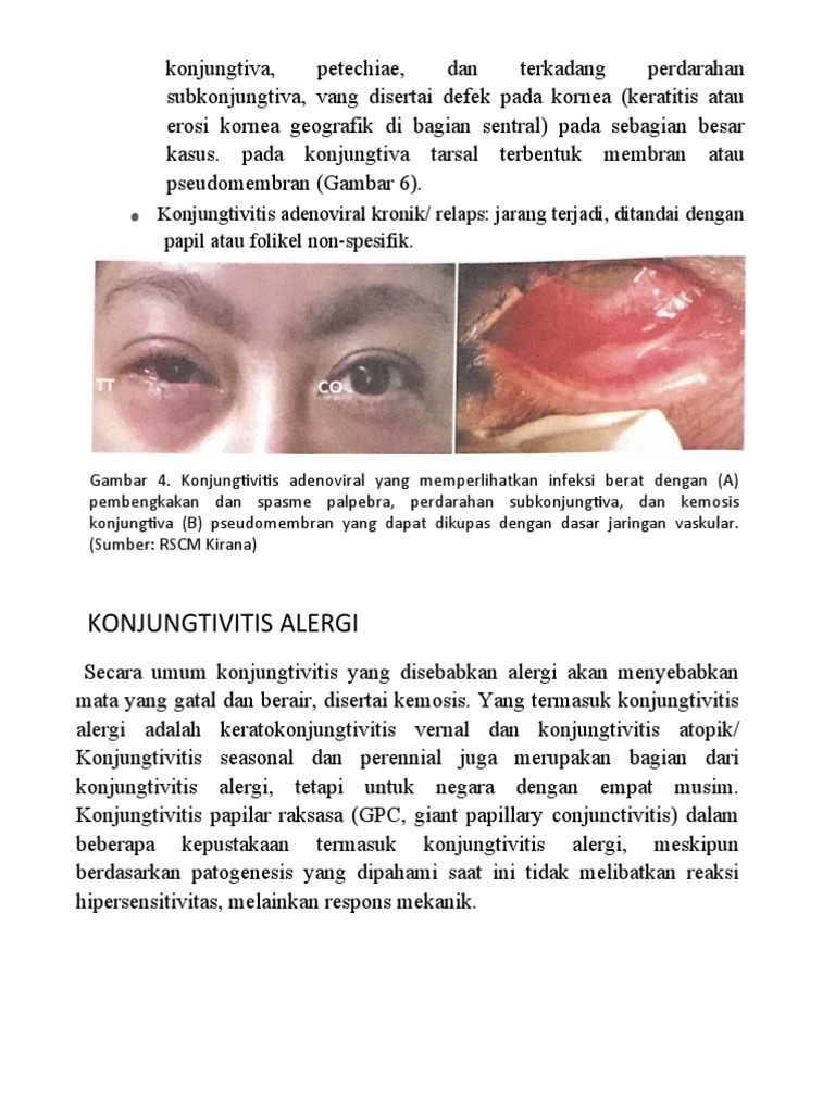 Konjungtivitis Alergi PDF