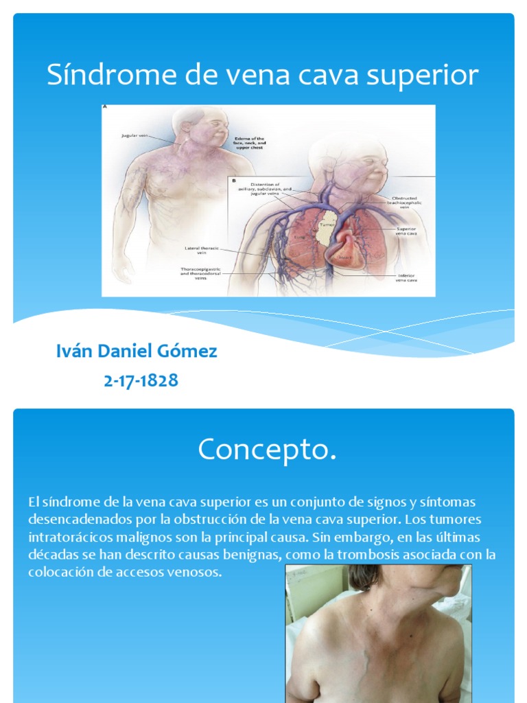 s-ndrome-de-vena-cava-superior-causas-y-tratamiento-pdf-c-ncer-vena