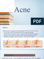 Kutil, Acne