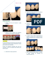 Preparo CavitÃ¡rio e RestauraÃ Ã o Classe III Com Compã Sitos (ACESSO VESTIBULAR)