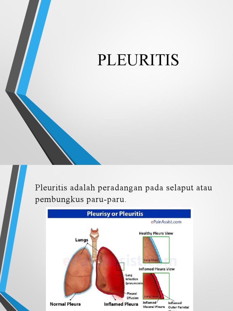 Pleuritis | PDF