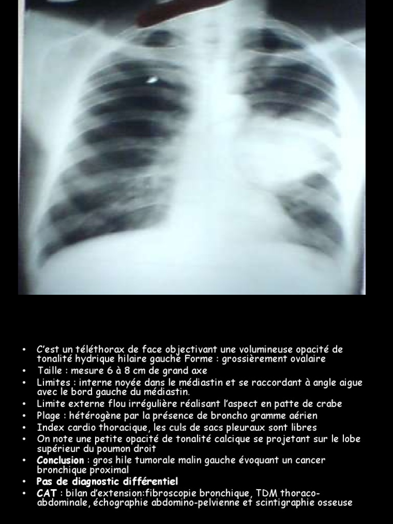Clichés Thoraciques Avec Interprétation | PDF