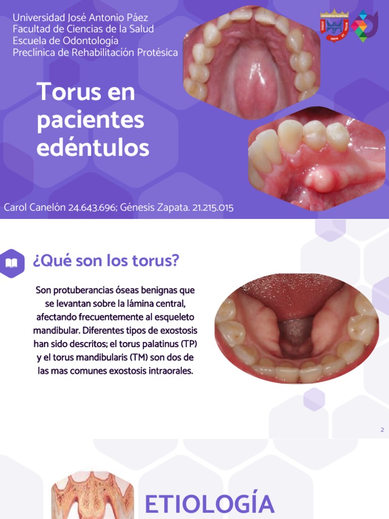 Tipos y tratamiento de torus en edéntulos | PDF | Dentadura postiza | Hueso