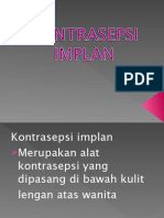 Kontrasepsi Implant PP