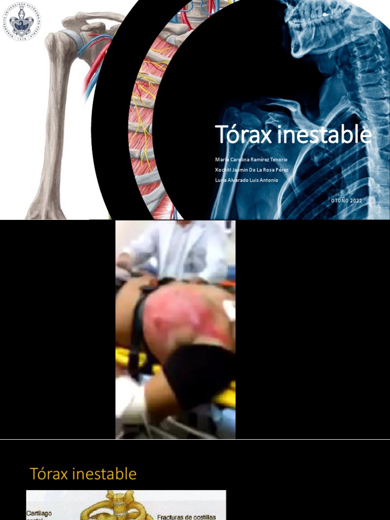 Tórax Inestable | PDF