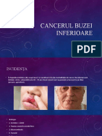 Cancerul Buzei Inferioare