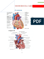 Insuficiencia Cardiaca