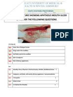 Mouth Ulcer - OSPE