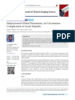 Subperiosteal Orbital Hematoma - An Uncommon Complication of Acute Sinusitis