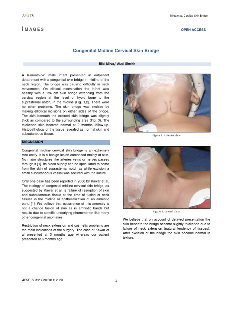 Congenital Midline Cervical Skin Bridge | PDF | Neck | Congenital Disorder