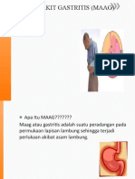 PP Gastritis