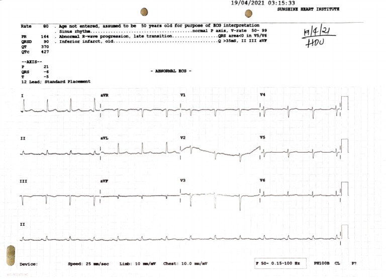 Naresh Ecg Report 19-Apr | PDF