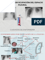 Patología Espacio Pleural