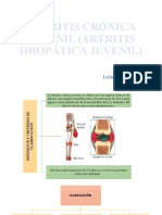 Artritis Crónica Juvenil (Artritis Idiopática Juvenil)