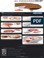 Searchq Cerebral+Hemorrhage+Symptoms&Rlz 1CDGOYI EnMY1010MY1010&Hl en GB&PRMD Ivn&Sxsrf ALiCzsZRIlvWhsEb