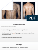 Pityriasis Versicolor