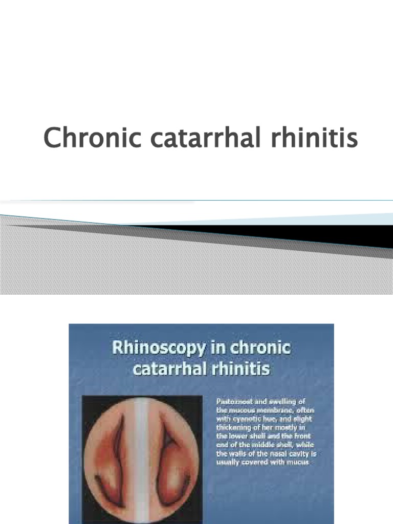 Chronic Catarrhal Rhinitis | Download Free PDF | Human Nose | Mucus