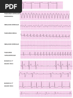 Ritmos Ecg Acls | PDF
