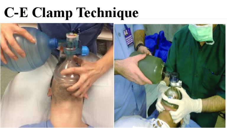 C-E Clamp Technique | PDF