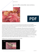 Causas de Ulceraciones Debajo de Las PPR A Extremo Libre - Cómo Resolverlas y Evitarlas (DR - Ernest Mallat)