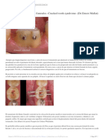 Tratamiento de Los Dientes Fisurados Cracked Tooth Syndrome (Dr.ernest Mallat)
