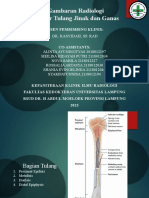 Tumor Tulang Ganas - Jinak